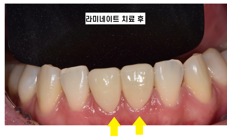 벌어진 아래 앞니 라미네이트로 감쪽같게 치료했습니다. 관련 이미지 6