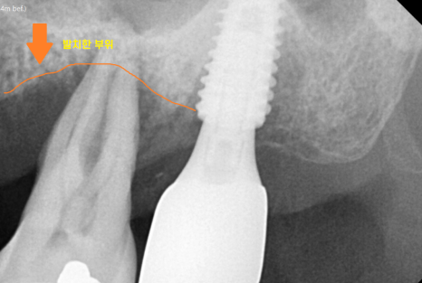 상일동 치과 잇몸 내려감 치료는 임플란트로 관련 이미지 5