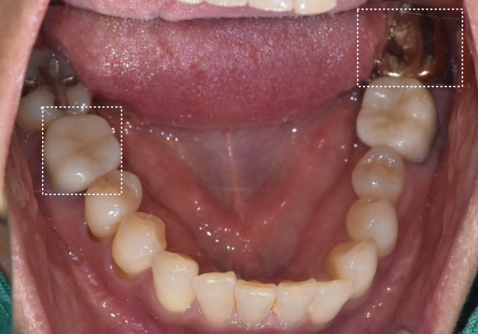 고덕역 임플란트, 뼈이식 꼭 해야 할까? 필수 상황 vs 제외 상황 총정리 관련 이미지 4