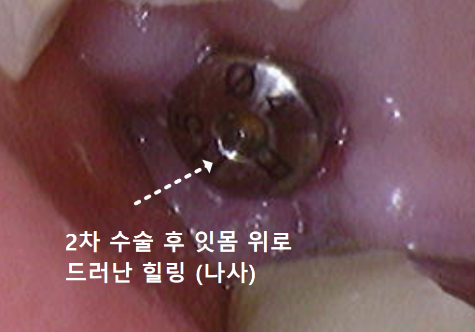 Sangil-dong Station Implant Visits: How Many Times Do You Actually Need to Go to the Dentist? image 5
