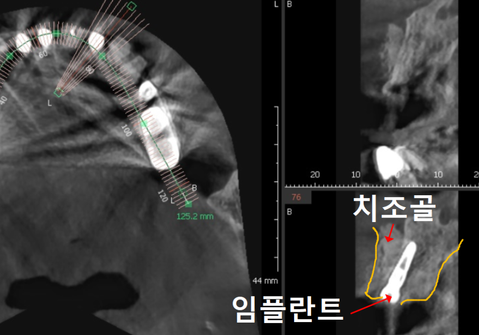 음식물 끼임, 거뭇한 무언가 보인다면? 이미 늦었을 수 있습니다. 관련 이미지 12