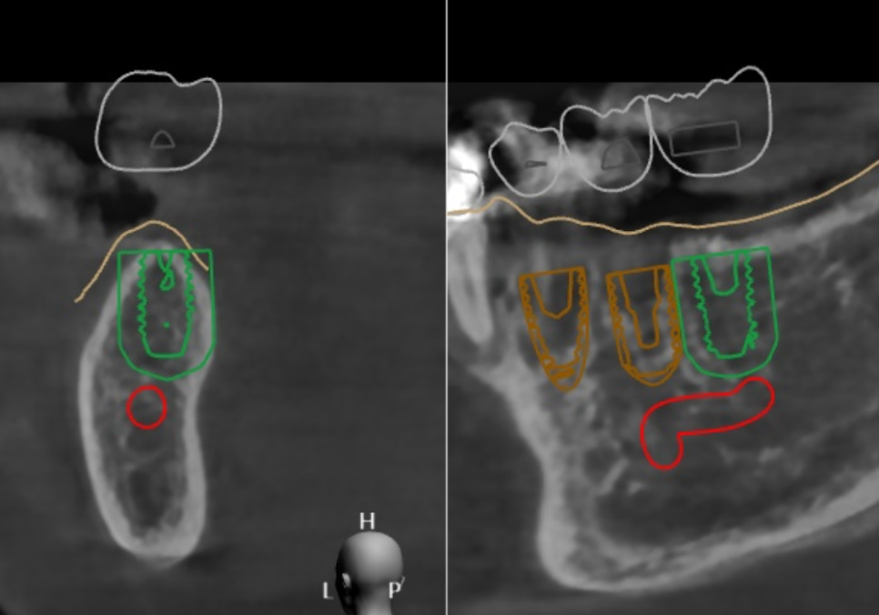 천호 디지털 가이드 임플란트, 일반 임플란트와 무슨 차이가 있나요? 관련 이미지 4