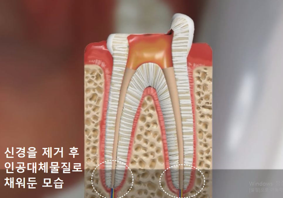 앞니 뿌리 염증, 자연치유될까? 아프지 않아도 치료가 필요한 이유 관련 이미지 1