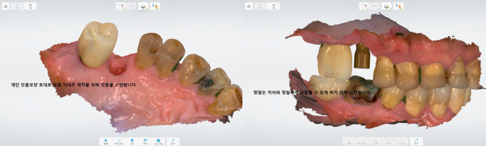 서울바르디치과 무절개 네비게이션 임플란트 치료증례 #8 관련 이미지 8