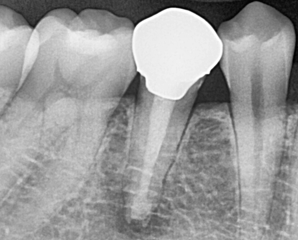 치아 멍 까맣게 변했어요 변색되고 괴사되었을 때 대처법 공개 관련 이미지 6