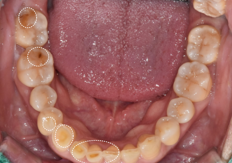 고덕동 심미 보철, 삐뚤어진 앞니, 교정 없이 바로잡은 비결 관련 이미지 13