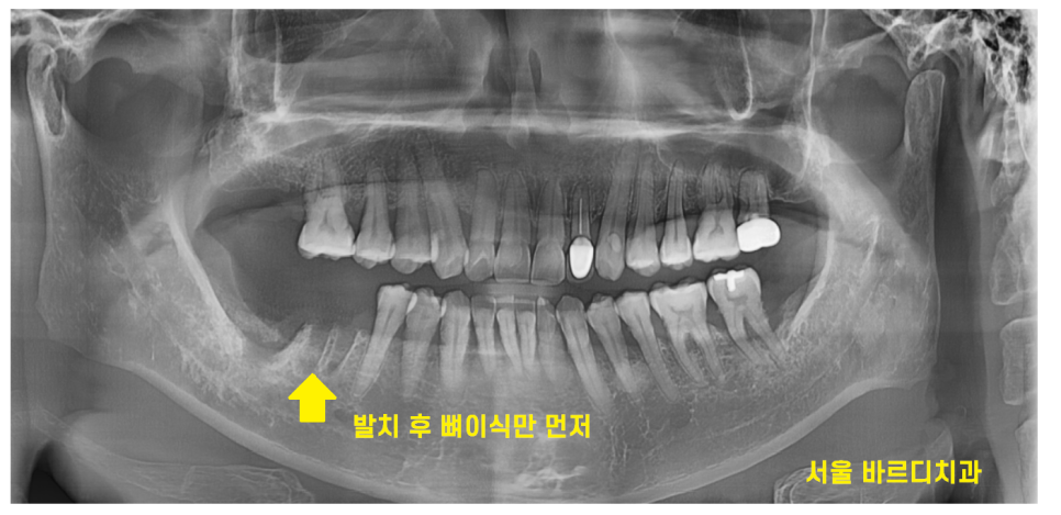 이 흔들림으로 발치 후 뼈이식 진행한 케이스 관련 이미지 6