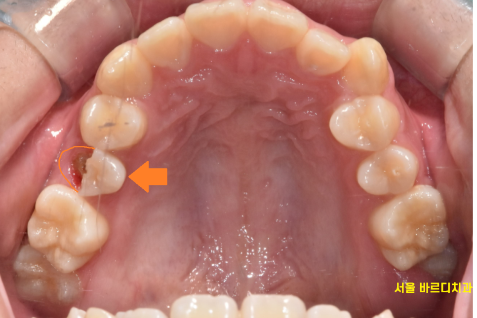 강일동 치과 추석 명절 딱딱한 음식은 절대 피하세요 치아 골절 생깁니다. 관련 이미지 2