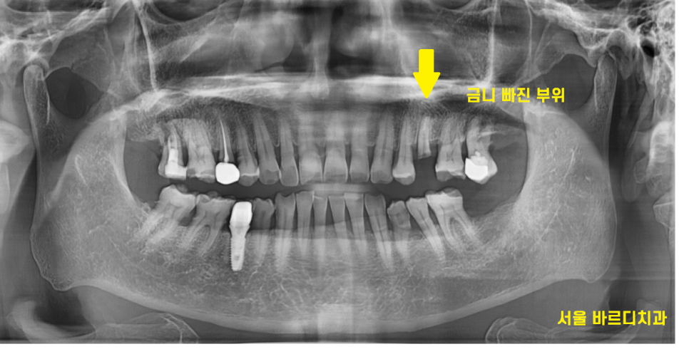 미사 임플란트 금니 빠짐 보철물 빠졌을 때 대처법 알려드려요 관련 이미지 2