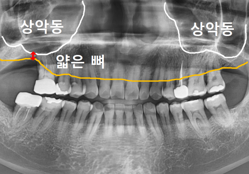 강동구 잇몸 퇴축으로 뿌리 드러난 치아, 이대로 둬도 괜찮을까? 관련 이미지 9