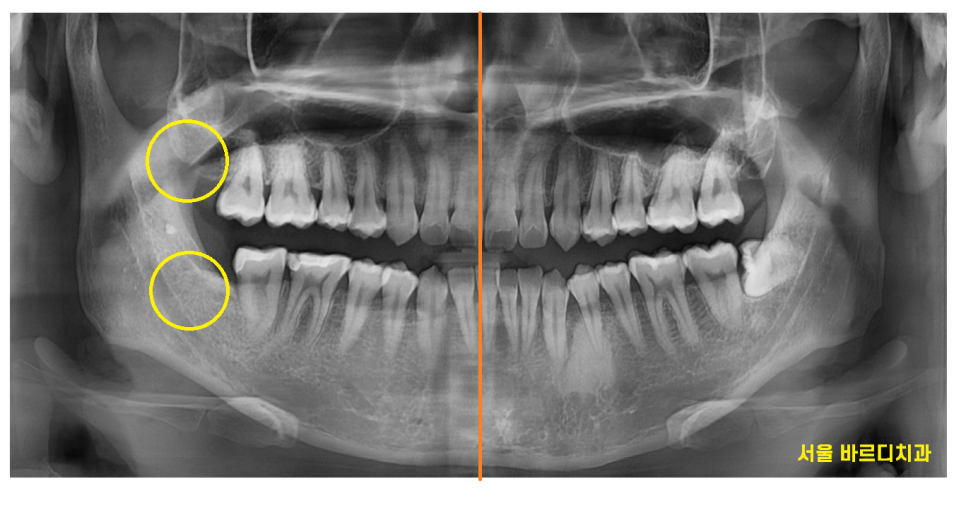 상일동 사랑니 발치  시간, 비용 절약하는 3가지 꿀팁 공개~! 관련 이미지 6