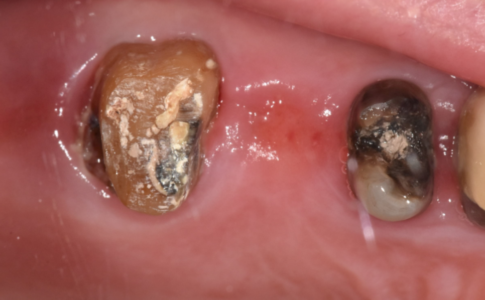 풍산동 치과 임플란트 시술후 통증 부작용은 아닐까? 관련 이미지 4