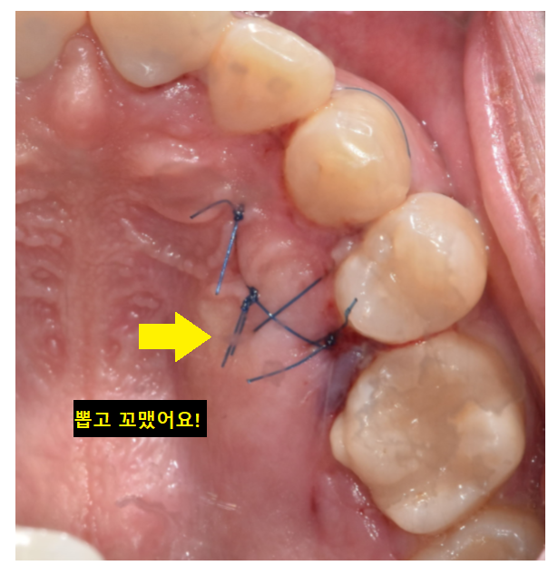 덕풍동 치과 교정 치료 위해 숨어있는 매복치 수술 발치 문제없습니다 관련 이미지 8