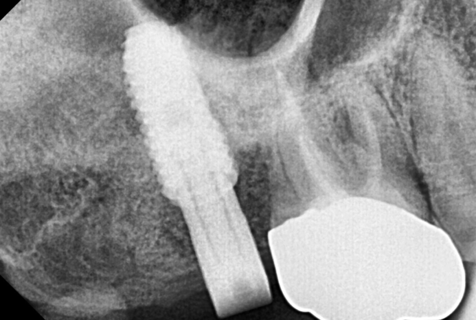 강동구 임플란트 뿌리 염증 심해질경우 대처 방법 관련 이미지 7