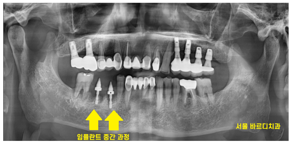 하남시청치과 치아 욱신거림 임플란트로 치료해드렸습니다. 관련 이미지 6