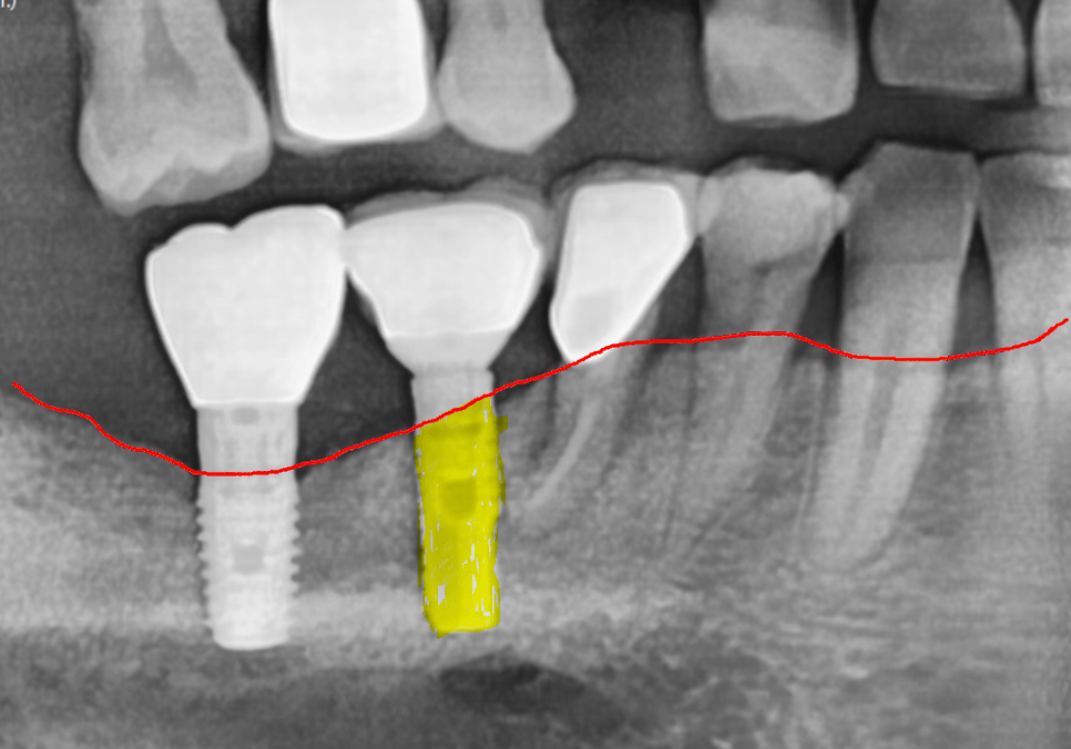 고덕 치과, 임플란트가 흔들려요. 뽑아야 할까 봐 고민이라면? 이렇게 해결합니다. 관련 이미지 2