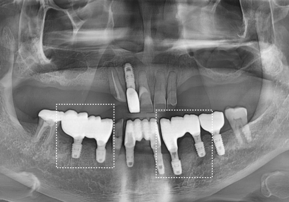 Cheonho Dental Clinic, Are You Over 65? We’re Revealing How to Reduce Denture and Implant Costs. image 11