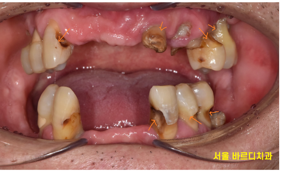 상일동 임플란트 잘하는곳 치료는 이렇게 진행됩니다. 관련 이미지 2