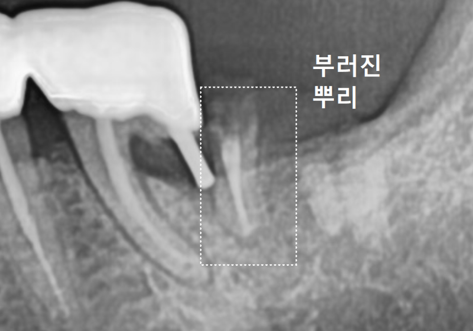 강동구 임플란트 기간, 사람마다 왜 다를까? 즉시식립과 지연식립의 결정적 차이 관련 이미지 13