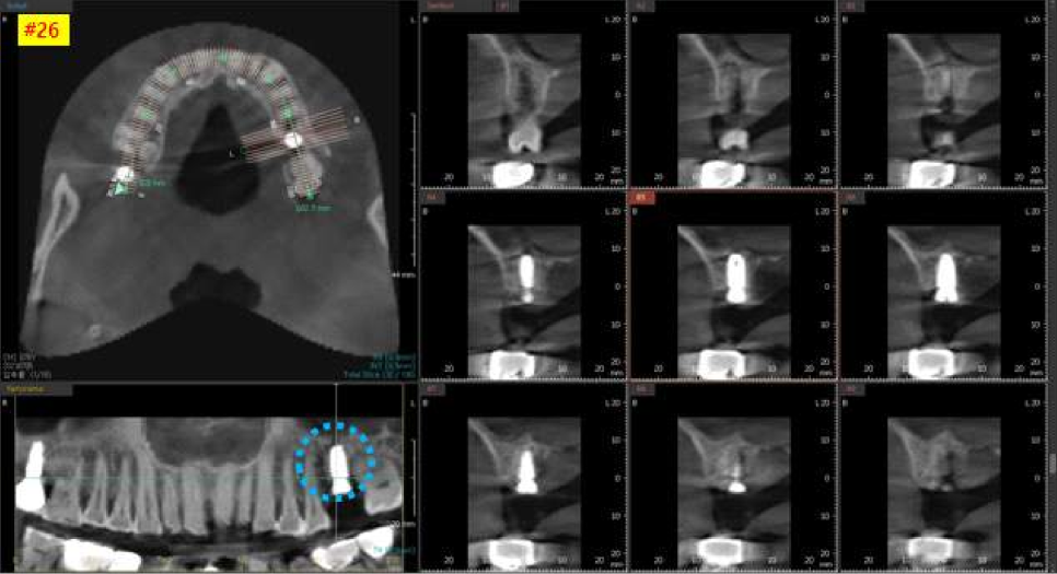 서울바르디치과 상하악 대구치 네비게이션 임플란트 치료증례 #4 관련 이미지 8