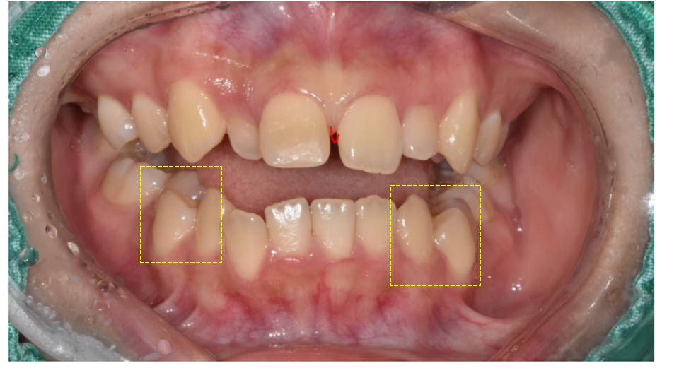 Microdontia Orthodontics Can Restore Balance and Alignment of the Teeth. image 5
