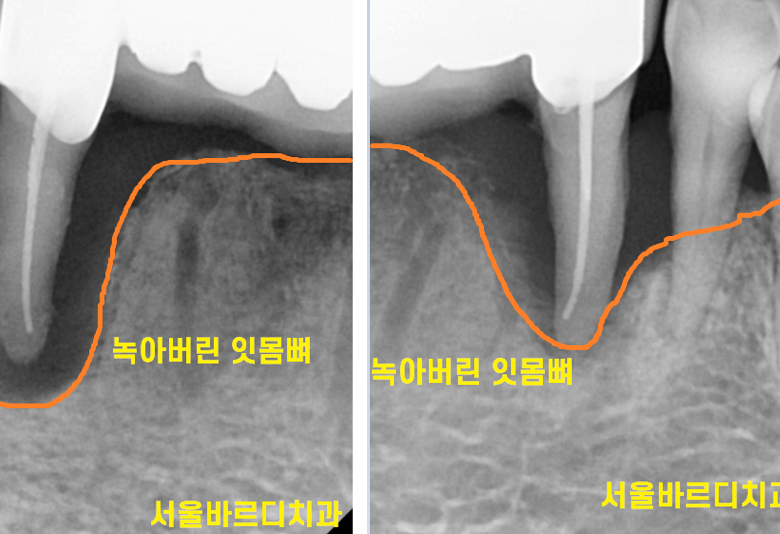 강동구 치과 앞니 흔들림 임플란트 케이스 관련 이미지 4