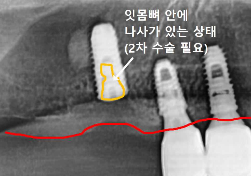 Sangil-dong Station Implant Visits: How Many Times Do You Actually Need to Go to the Dentist? image 4