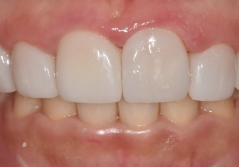 천호 라미네이트 파절 탈락, 줄이려면 치과 선택이 중요합니다. 관련 이미지 11