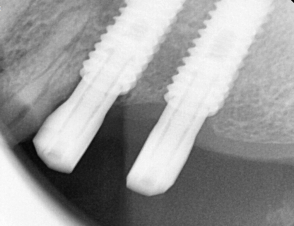 천호동 치과 자연 발치 후 방치된 치아 임플란트 케이스 관련 이미지 10