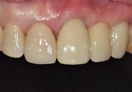 오래된 앞니 크라운 냄새, 관련 이미지 12