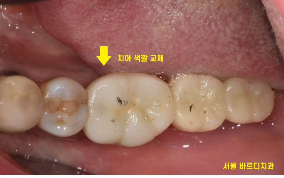 풍산동 치과 임플란트 시술후 통증 부작용은 아닐까? 관련 이미지 9