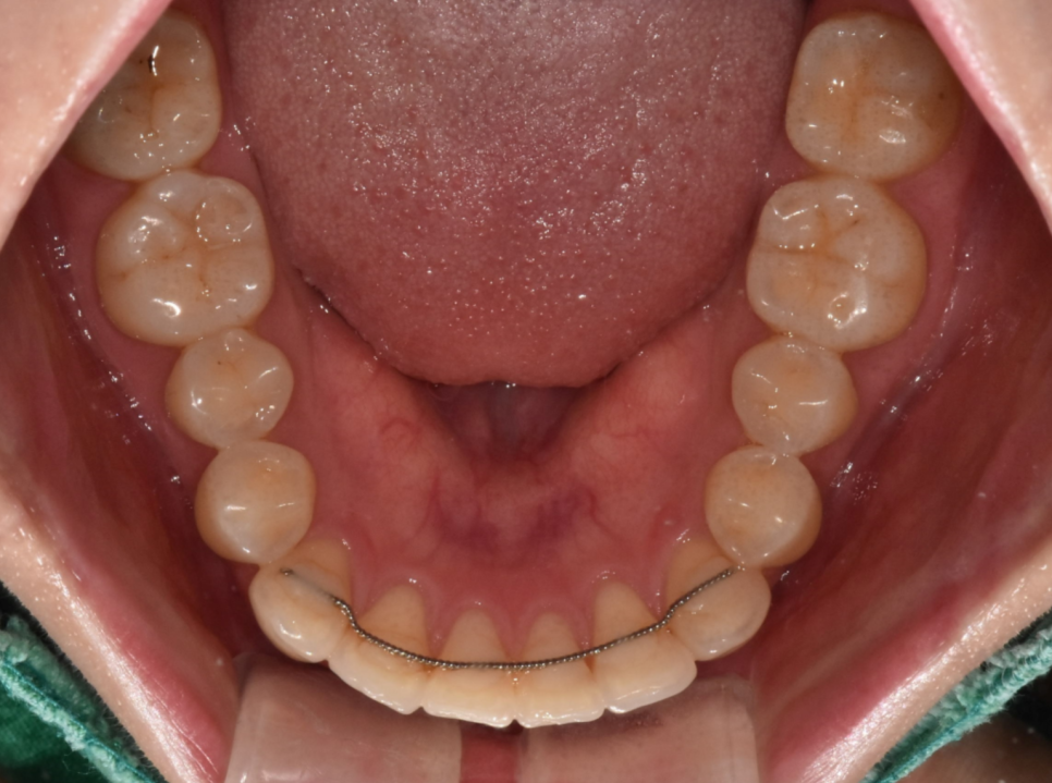 치아교정 재교정 다시 삐뚤어진 치아 원인과 해결방법은? 관련 이미지 5