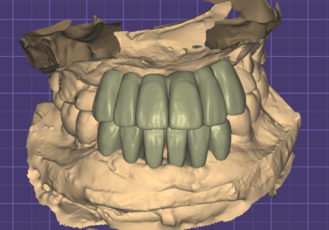 대문니 파절, 앞니에 금이 쩍 갈라졌다면? 딱딱한 음식을 조심해야 하는 이유 관련 이미지 11