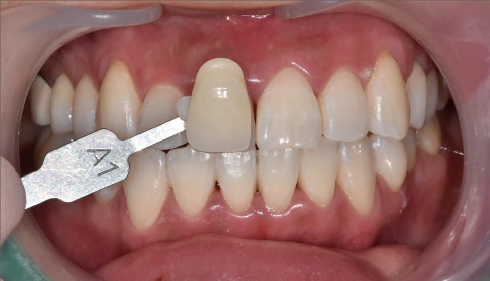 강동구 치아 미백 과정 확인하고 환한 미소로 웃어봐요 우리 관련 이미지 7