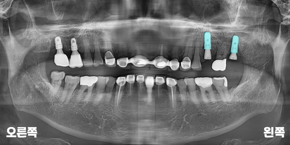 서울바르디치과 뿌리 끝 염증 심한 치아를 네비게이션 임플란트 #6 관련 이미지 11