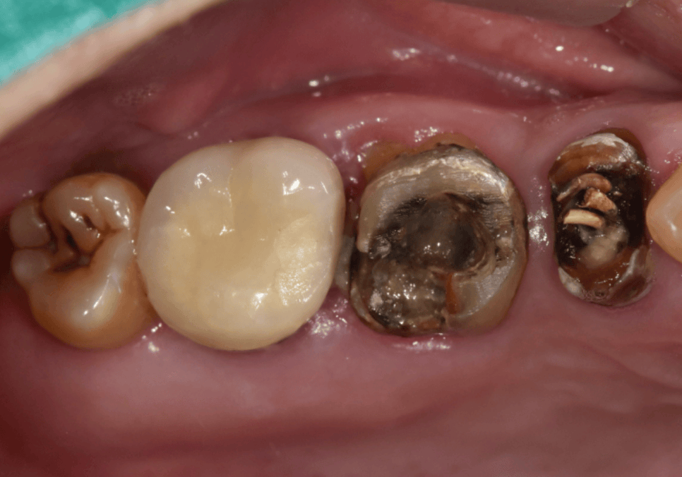 강동구 오래된 보철, 교체 시기는? 아프지 않은데 꼭 바꿔야 하나요? 관련 이미지 8