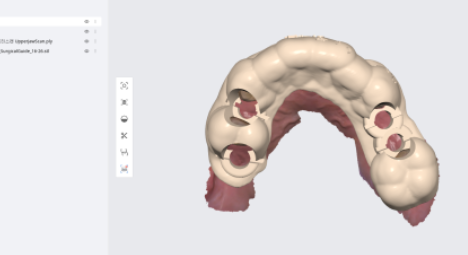 고덕동 임플란트 통증 걱정으로 수술 엄두가 안나시는 분들께 관련 이미지 4