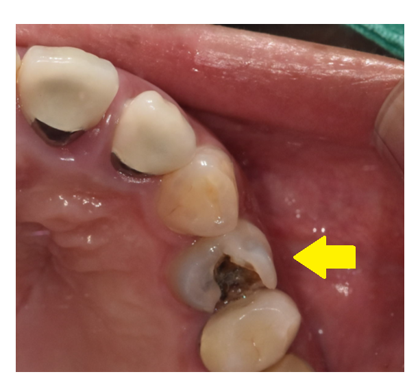 충치치료 후 이시림 자연스러운 반응일까 후유증일까? 관련 이미지 5