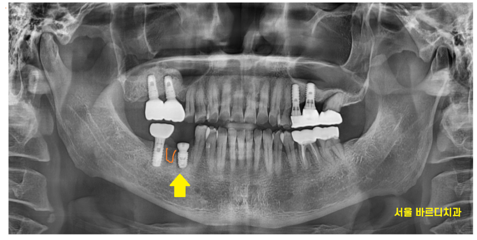 미사역 임플란트 잇몸이 풍선처럼 부풀어오르는 치주농양 환자분 관련 이미지 5