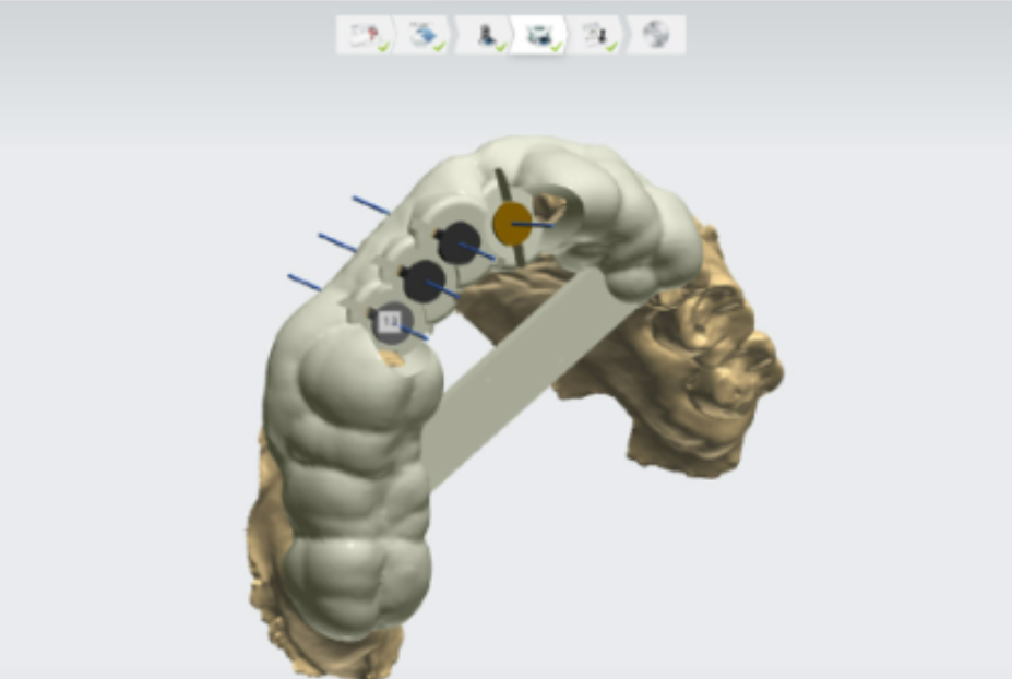 뿌리만 남은 치아, 그대로 두면 왜 위험할까요? 고덕동 전체 임플란트 재건 사례 관련 이미지 13