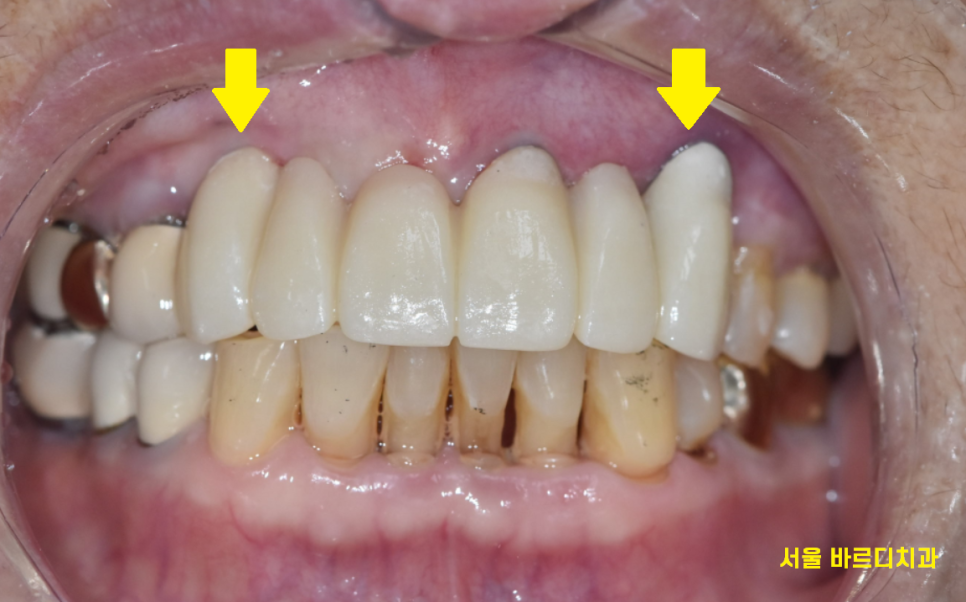 하남미사치과 앞니 브릿지를 임플란트로 교체했습니다. 관련 이미지 8