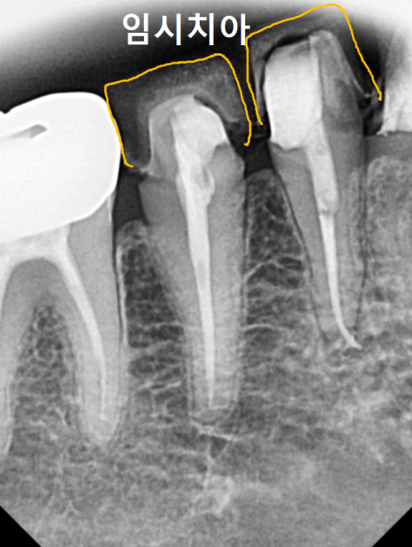 Honestly, Can an Unbroken Temporary Tooth Be Used Without a Crown? image 6