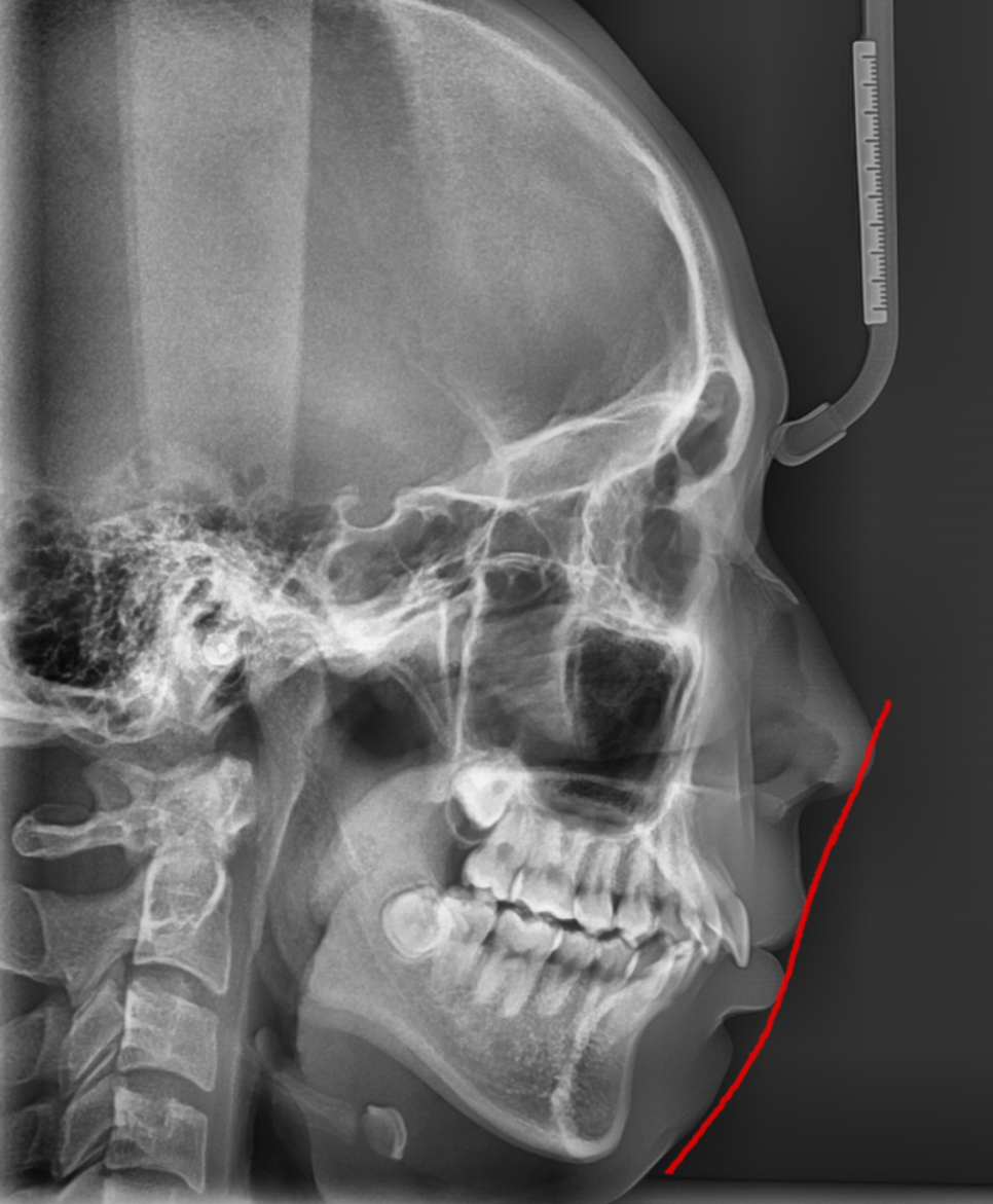 입툭튀 교정 돌출입 수술 없이 가능할까? 관련 이미지 2