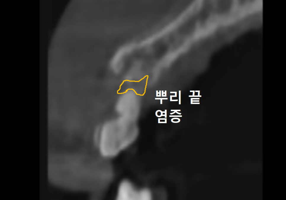 흔들리는 성인 잔존 유치, 50년 만에 송곳니 임플란트 하게 된 사연 관련 이미지 6