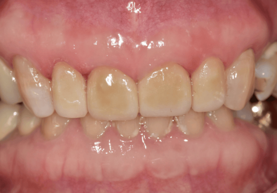 중장년 라미네이트, 70대도 가능한가요? 왜소치와 벌어진 앞니 해결 사례 관련 이미지 13