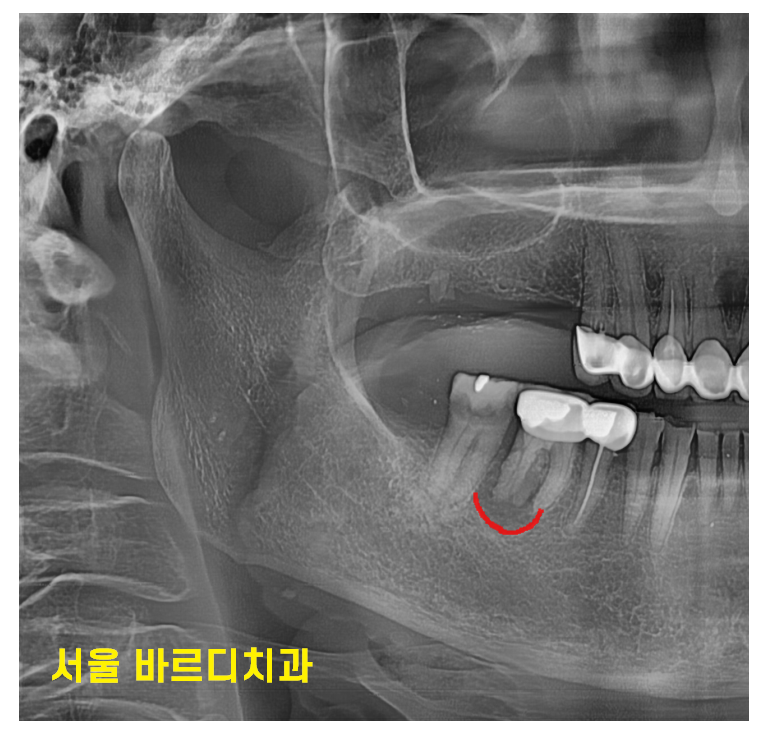 하남 임플란트 치과 주문진에서부터 치료 받으러 오신 환자분 관련 이미지 7