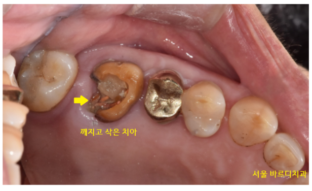 치아 크라운 빠짐 살릴 수 없을 때 강일역 임플란트 관련 이미지 5