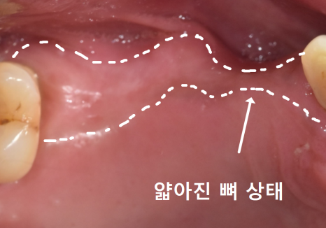 위 턱 전체 임플란트 vs 부분 틀니, 나에게 꼭 필요한 치료법 찾기 관련 이미지 9