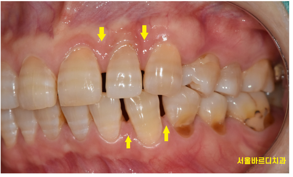 앞니 치아 사이 벌어짐 라미네이트로 컴플렉스 극복! 관련 이미지 2