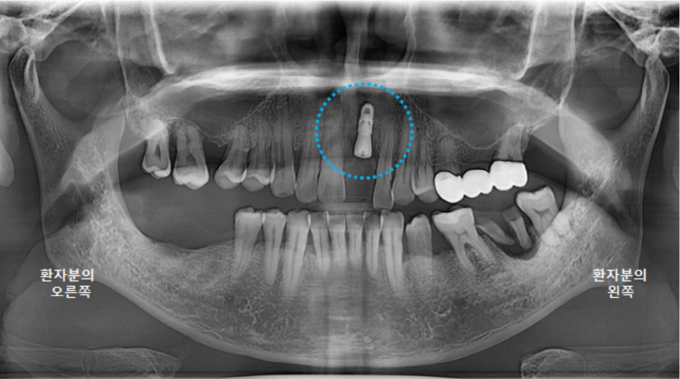 고덕동치과 서울바르디치과 전치부 및 구치부 임플란트 치료증례 #9 관련 이미지 3